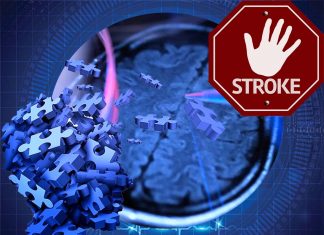 Changes in immune profile two days after stroke can predict the likelihood of dementia a year later