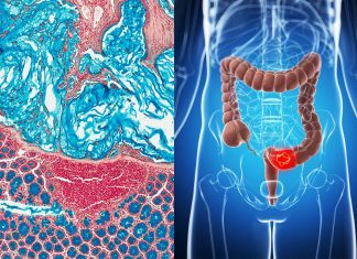 Colorectal cancer is the second deadliest cancer