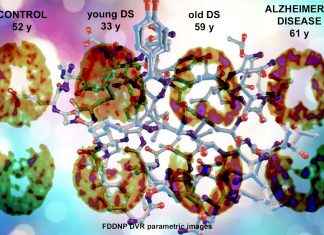 Found link between Alzheimer’s Disease and Impairments in insulin signaling