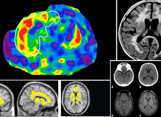HIV : brain atropgy can be seen in scan before clinical symptoms appear