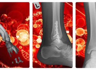 Increases in chronic inflammation is the main reason why injured bones do not heal as well with age