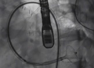 Israel : first world heart procedure – treat hole in the artery using a device that is usually used to unblock arteries