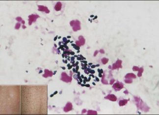 A fungus commonly found in human hair follicles might play a role in Crohn’s disease