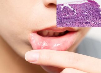 Mouth ulcers affect up to 25 per cent of young adults and children