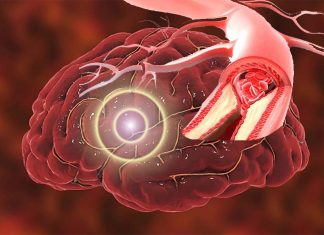 New approach significantly minimized brain damage caused by stroke