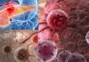New therapeutic approach for patients with pancreatic cancer