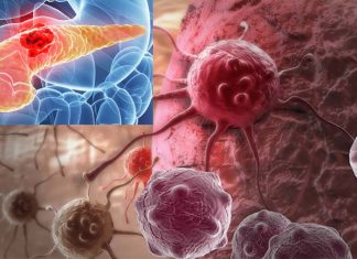 New therapeutic approach for patients with pancreatic cancer