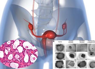 Ovarian cancer it’s among the deadliest