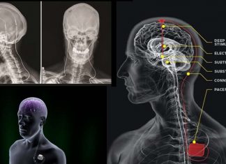Parkinson’s disease : deep brain stimulation helps tackle symptoms