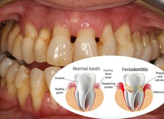 Periodontitis increase risk of developing Alzheimer’s disease
