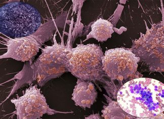 Prostate cancer cells change the behaviour of other cells around them helping the cancer hide from the body’s immune system