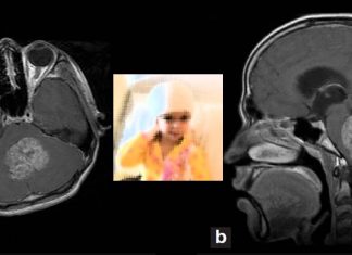 Radiation immediately following surgery in children with ependymoma can nearly triple survival