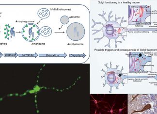 Researchers are focus on restoring normal levels of autophagy in neurons of Alzheimer’s disease to treat it