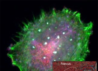 Researchers found that inhibition HAT enzyme prevents growth of human melanoma