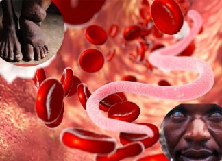 Researchers has found a cure for river blindness and elephantiasis
