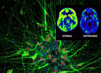 Researchers have found link between neuron abnormal shape and major depressive disorder