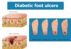 Researchers have identified the mechanism of impaired wound healing in diabetes