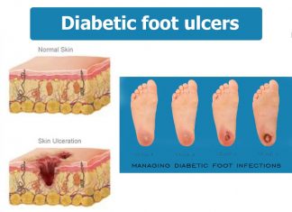 Researchers have identified the mechanism of impaired wound healing in diabetes