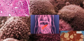 Scientists discovered a technique to starve pancreatic cancer cells reliant and kill it