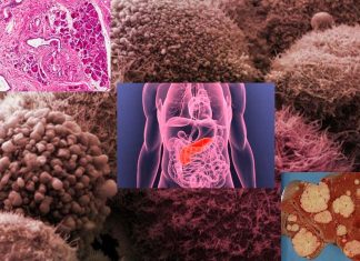 Scientists discovered a technique to starve pancreatic cancer cells reliant and kill it