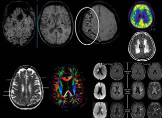 Seemingly harmless fluid-filled spaces around the cerebral small vessels are associated with compromised cognitive skills