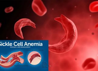 Sickle cell disease : new results could lead to new treatments