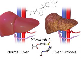 The drug Sivelestat may lower portal hypertension in patients with chronic liver disease