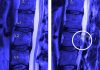 Spinal surgery: stay awake halve recovery time