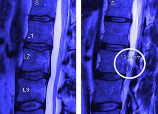 Spinal surgery: stay awake halve recovery time