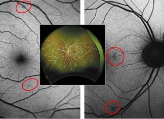 The loss of blood vessels in the retina could signal Alzheimer’s disease