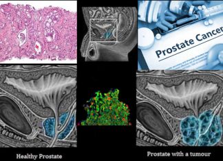 The development of effective anti-androgen therapies for prostate cancer is a major scientific advance