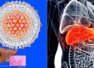When cancer spreads to another organ, it most commonly moves to the liver…. here’s why
