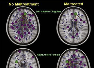 Early life trauma may affect the structure of the brain and develop severe depression
