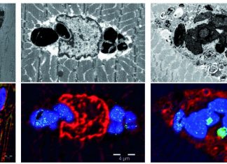 Myoglobinopathy : new muscular disease caused by a mutation in the myoglobin gene