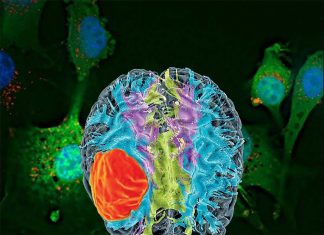 Researchers have discovered a new compound to treat glioblastome