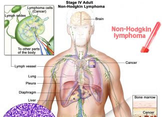 Prolonged HIV viremia is an independent risk factor for non-Hodgkin lymphoma – antiretroviral therapy crucial in preventing non-Hodgkin lymphoma