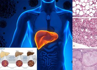 About 100 million U.S. adults and children living with nonalcoholic fatty liver disease (NAFLD)
