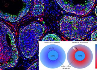 Researchers has found that tumor surfaces are also highly acidic helping invasivity and metastatic