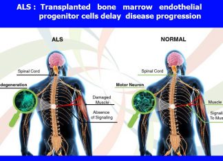 ALS : Transplanted bone marrow endothelial progenitor cells delay disease progression