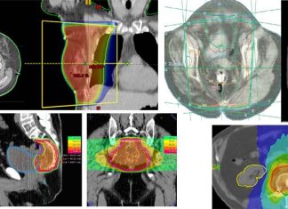 Amifostine : new drug used to protect healthy tissue in patients undergoing radiation therapy