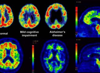 Amyloid PET imaging improve diagnosis and Alzheimer’s treatment