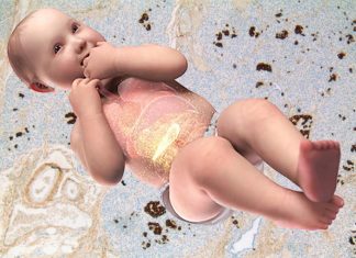 Babies born with congenital hyperinsulinism (CHI) are at risk of suffering from permanent brain damage