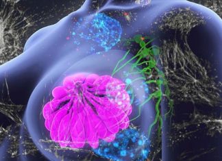 By removing breast cancer, an immune response is triggered to destroy cancer cells