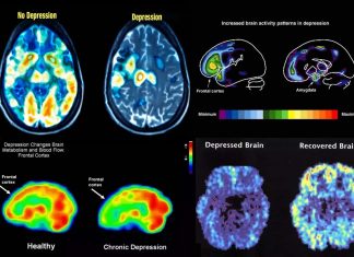 Depression it’s not heritable genetic’s linked
