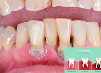 Gum disease exude toxins associated with Alzheimer’s disease, rheumatoid arthritis, and aspiration pneumonia