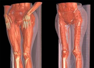 Limb girdle muscular dystrophy : Lithium boosts muscle strength