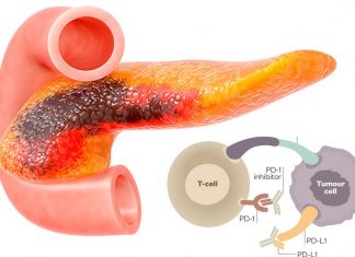 New combination therapy can be effective against pancreatic cancer