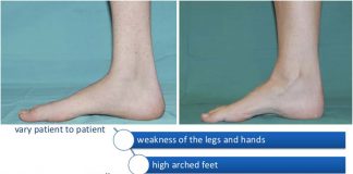 New possible treatments for Charcot-Marie-Tooth disease