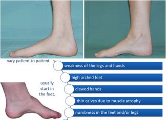 New possible treatments for Charcot-Marie-Tooth disease