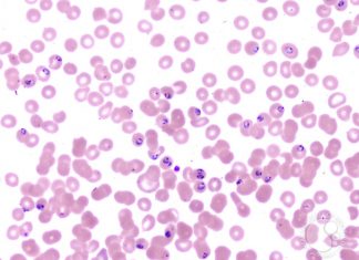 Blood group A, B and AB could facilitate progression to severe malaria